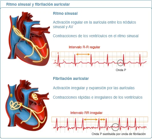 Diferencia entre taquicardia y fibrilación auricular