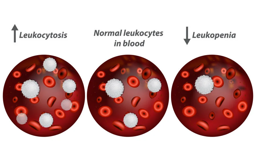 Diferencia entre leucocitosis y leucopenia