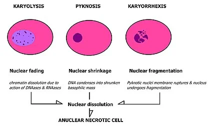 Diferencia entre picnosis cariólisis y cariorrexis