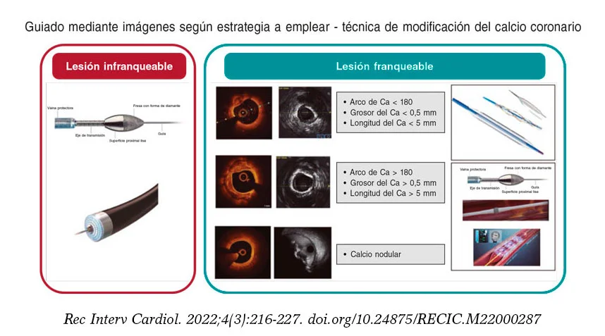 Diferencia entre placa y calcificación
