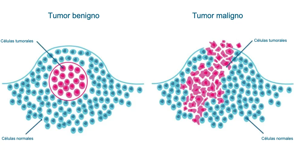 Diferencia entre tumor y neoplasia