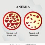 Diferencia entre anemia y hemofilia
