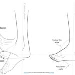 Diferencia entre dorsiflexión y flexión plantar