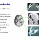 Diferencia entre el LCR y la secreción nasal