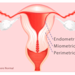 Diferencia entre endometrio y miometrio