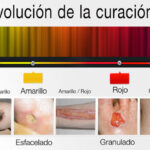 Diferencia entre epitelización y granulación