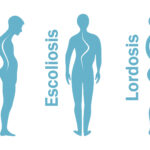 Diferencia entre escoliosis cifosis y lordosis