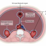 Diferencia entre intraperitoneal y retroperitoneal