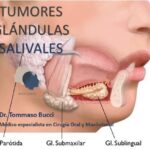 Diferencia entre la glándula salival y el ganglio linfático