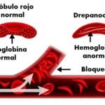 Diferencia entre la hemoglobina normal y la hemoglobina falciforme