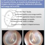 Diferencia entre la membrana timpánica derecha e izquierda