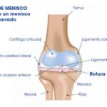 Diferencia entre menisco y cartílago