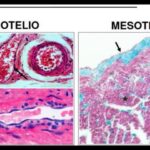 Diferencia entre mesotelio y endotelio