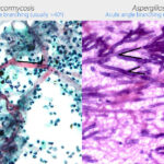 Diferencia entre Mucor y Aspergillus