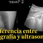 Diferencia entre rayos X y ultrasonido
