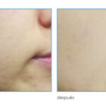 Diferencia entre un tratamiento facial y una limpieza