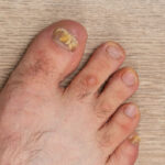 ¿Qué causa los hongos en las uñas de los pies? ¿Cómo tratarlos?