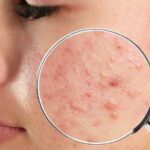 Diferencia entre acné y espinilla Salud