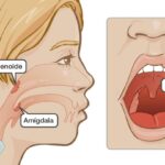 Diferencia entre adenoides y amígdalas Ciencia