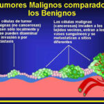 Diferencia entre benigno y maligno