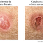 Diferencia entre células basales y células escamosas