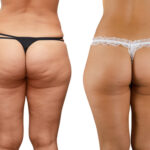 Diferencia entre celulitis y grasa