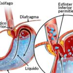 Diferencia entre el esfínter esofágico superior e inferior
