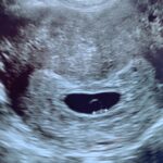 Diferencia entre el saco vitelino y el polo fetal