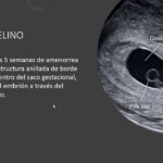 Diferencia entre el saco vitelino y el saco gestacional