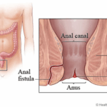 Diferencia entre fisura y fístula