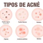 Diferencia entre grano y espinilla