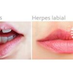 Diferencia entre herpes labial y aftas bucales