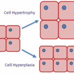Diferencia entre hiperplasia e hipertrofia