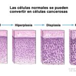 Diferencia entre hiperplasia y neoplasia