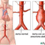 Diferencia entre la aorta torácica y la abdominal