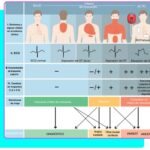 Diferencia entre la troponina I y la troponina T