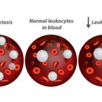 Diferencia entre leucopenia y neutropenia
