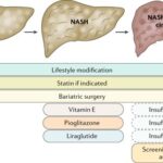 Diferencia entre NASH y NAFLD