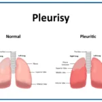 Diferencia entre neumonía y pleuresía