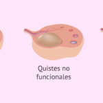 Diferencia entre óvulos y quistes