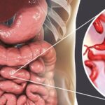 Diferencia entre oxiuros y lombrices intestinales