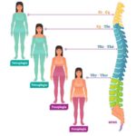 Diferencia entre paraplejía y tetraplejía