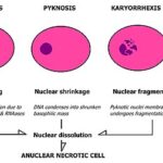 Diferencia entre picnosis cariólisis y cariorrexis
