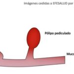 Diferencia entre sésil y móvil