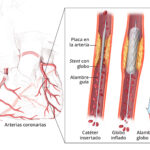 Diferencia entre stent y catéter