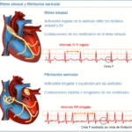 Diferencia entre taquicardia y fibrilación auricular