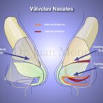 Diferencia entre válvulas y tabique