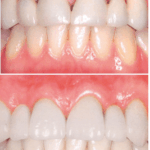 Diferencia entre zirconia y porcelana
