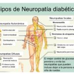 ¿Qué otras causas de la neuropatía además de la diabetes?